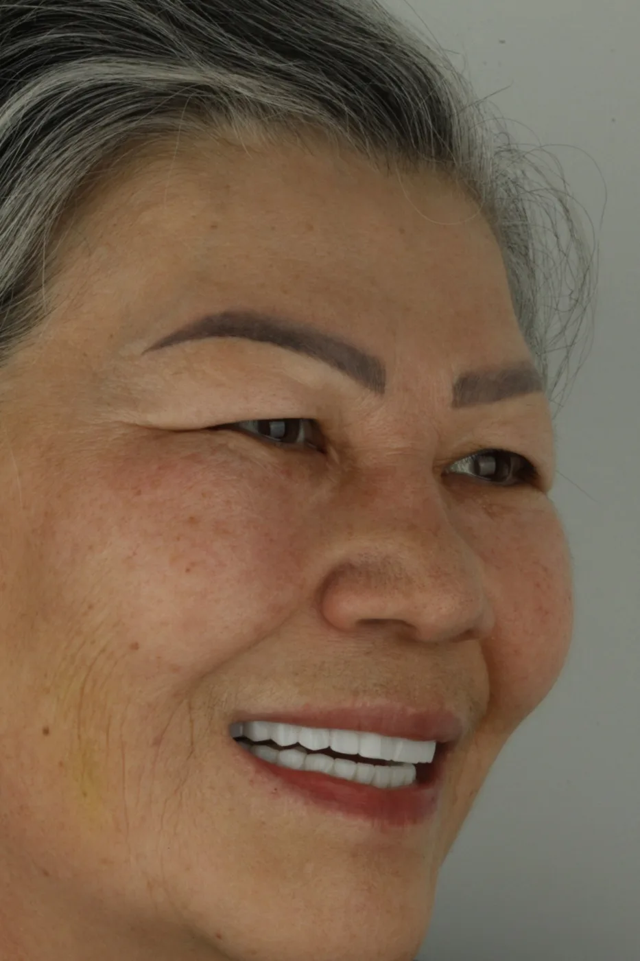 Bir hastanın yakın çekilmiş profil gülümseme karesi